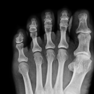 xray foot, x ray toes