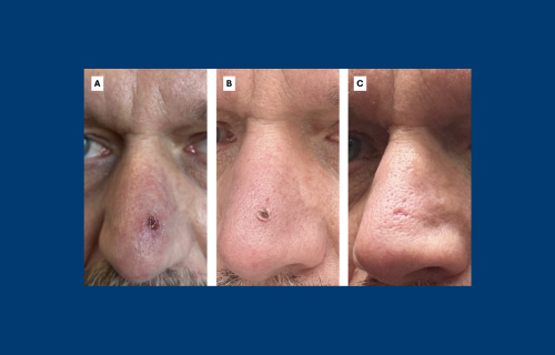 Breakthrough Mpox Case Identified in Ireland Despite Vaccination